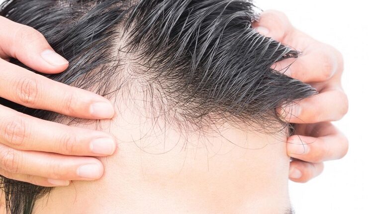 Hair Loss