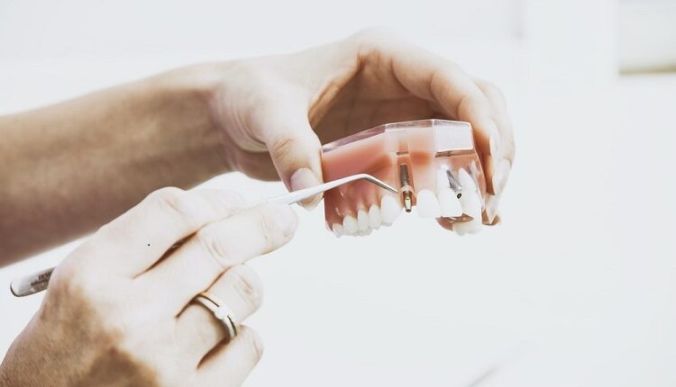 Dental Implants