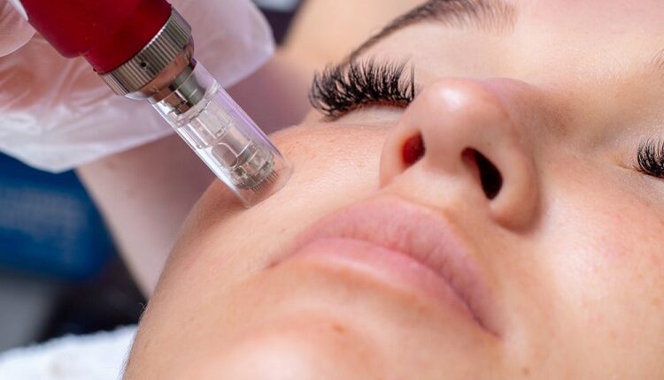 Microneedling